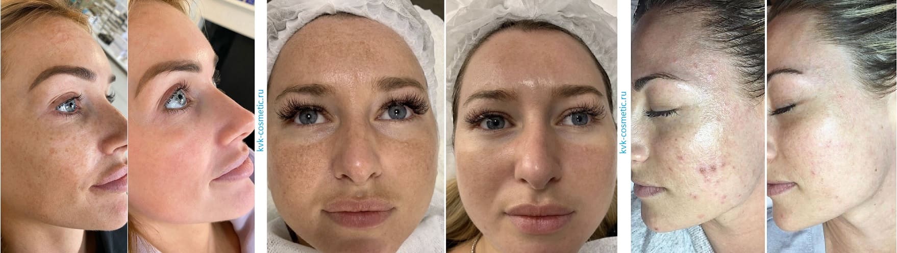 Лечение проблемной кожи лица: фото до и после, клиника косметологии В.Н. Комаровой в Туле