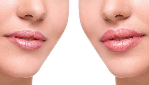 увеличение объема губ: самые эффективные способы для красивых губ