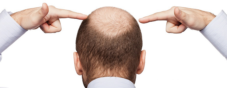 Лечение выпадения волос у мужчин и женщин в Туле