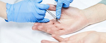 Лечение гипергидроза рук